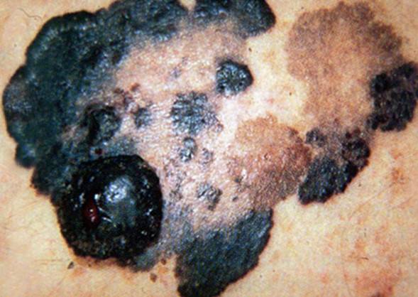skin cancer